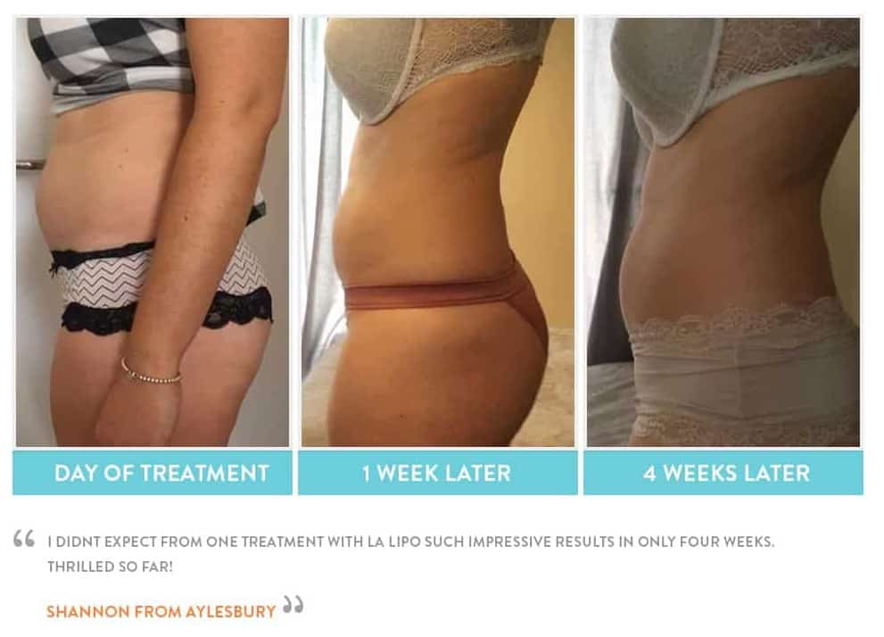 before, Cryolipolysis Hereford
