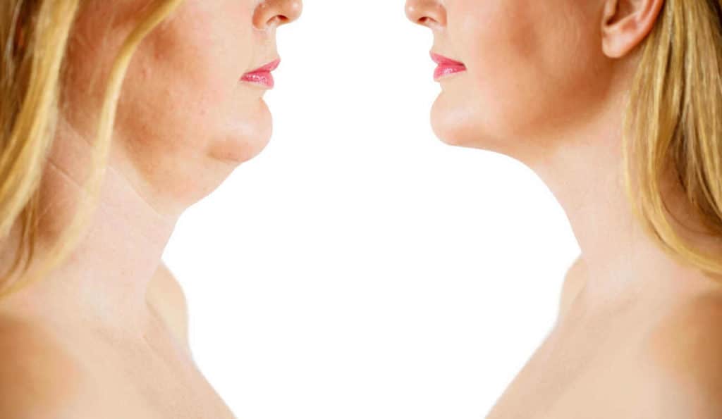 Double Chin treatment Hereford before and after results