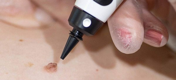 After Skin Tag Removal Hereford