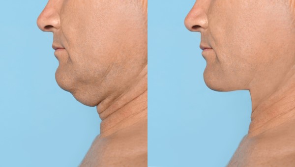 Which Non-Surgical Treatments Work Best for Jowls and Loose Skin Hereford?