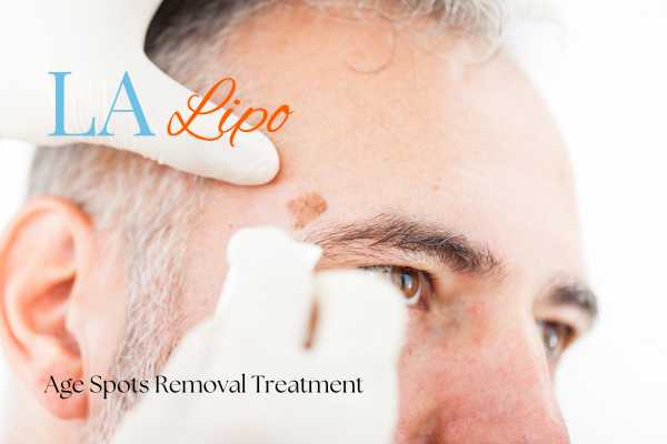 What Are the Most Effective Treatments for Age Spots Hereford?
