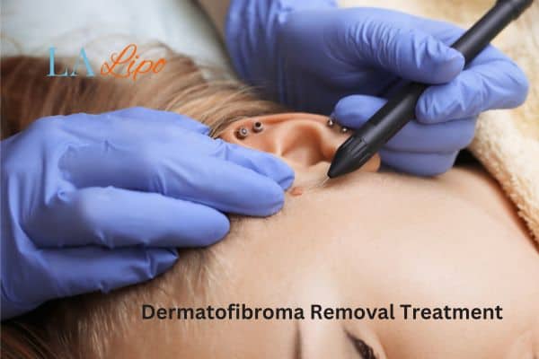 Dermatofibroma Removal Treatment Hereford