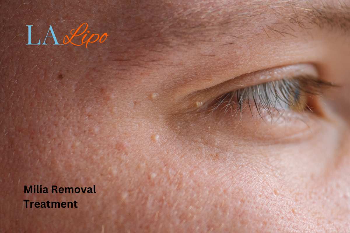 Cryopen Milia Removal: Is It the Easiest and Safest Option Hereford?