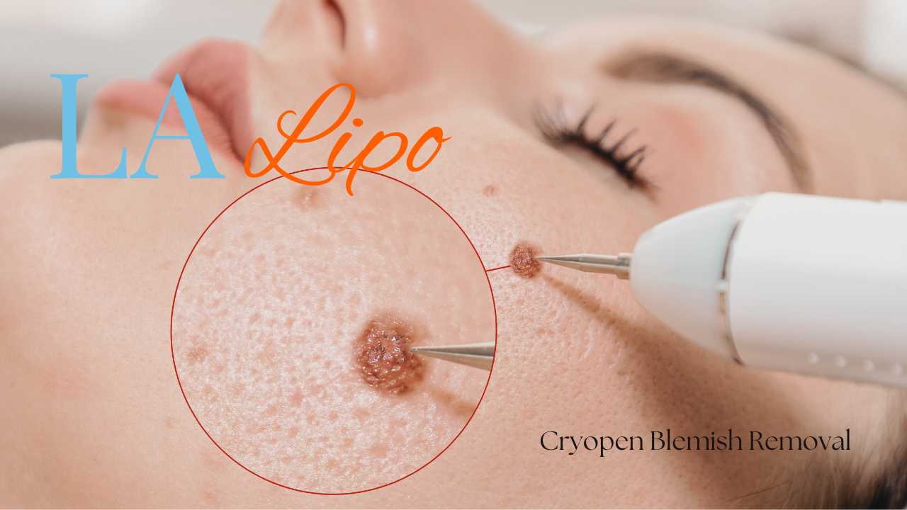 cryopen blemish removal Hereford Contact our team today!