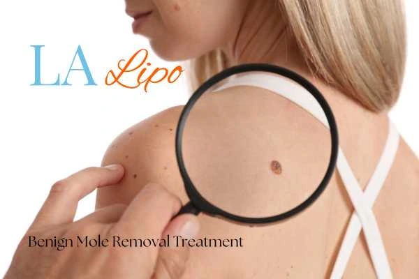 Woman having her inspection of blemish before mole removal Hereford