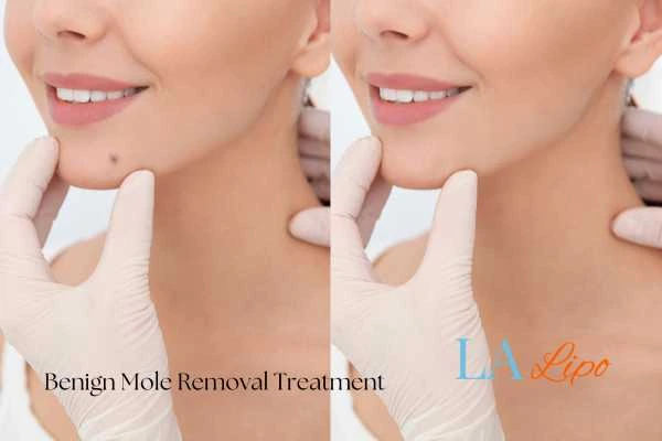woman's before and after mole removal Hereford results