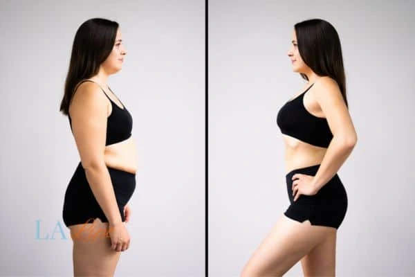 image of woman before and after results of LA-EMS Body Sculpting Hereford to help treat Diastasis recti