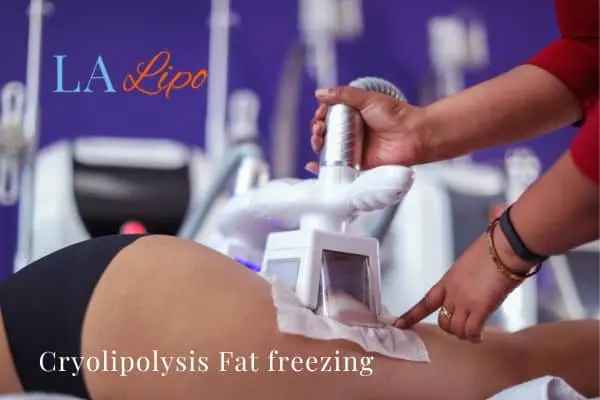women getting fat freezing Hereford