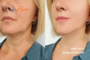 hi-fu for wrinkles Hereford before and after results