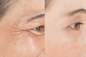 Before and after results of woman - HI-fu wrinkles reduction treatment Hereford