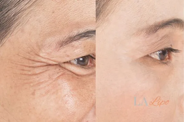 Before and after results of woman - HI-fu wrinkles reduction treatment Hereford