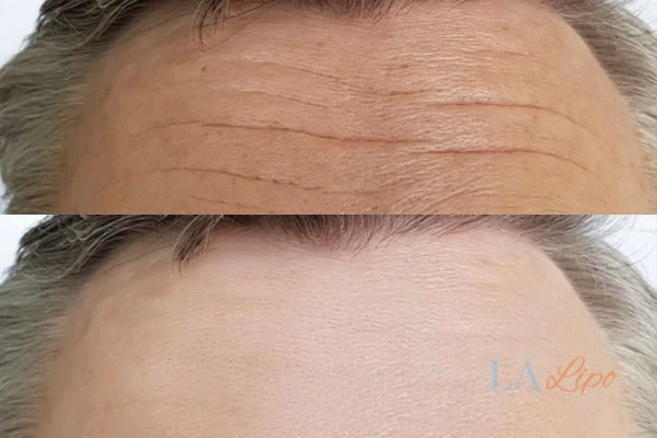 results of HIFU Hereford on mans forehead to help reduce lines and wrinkles