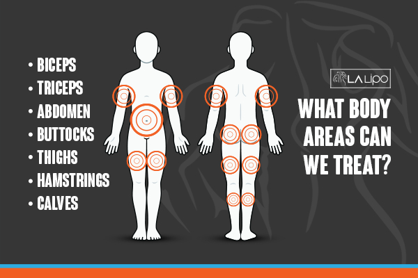 Graphic to show areas you can have LA-EMS Body Sculpting Hereford treatment.
