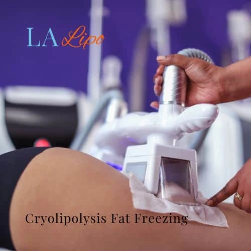 fat freezing - Cryolipolysis Hereford