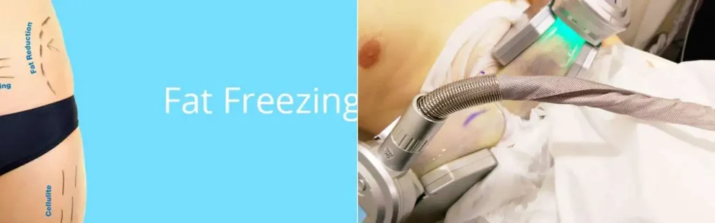 Fat freezing Hereford on multiple areas of the body