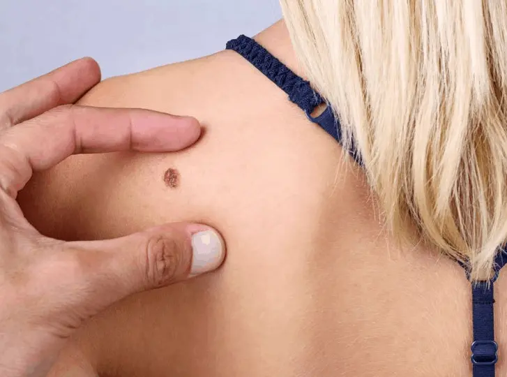 woman having mole removal Hereford consultation before treatment.