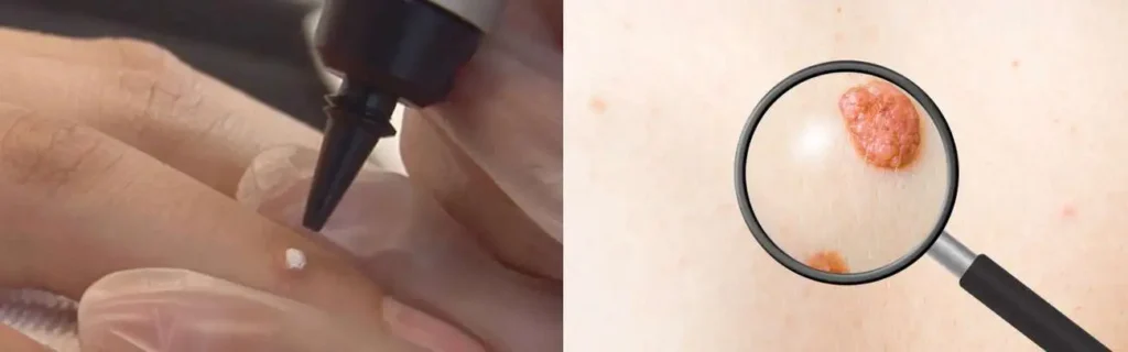 Cryopen for mole removal Hereford - speak to our team today!