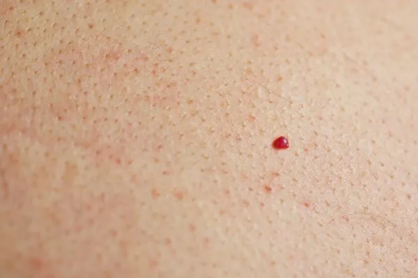 close up of a cherry angioma Hereford