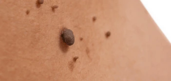 image of a skin tag Hereford