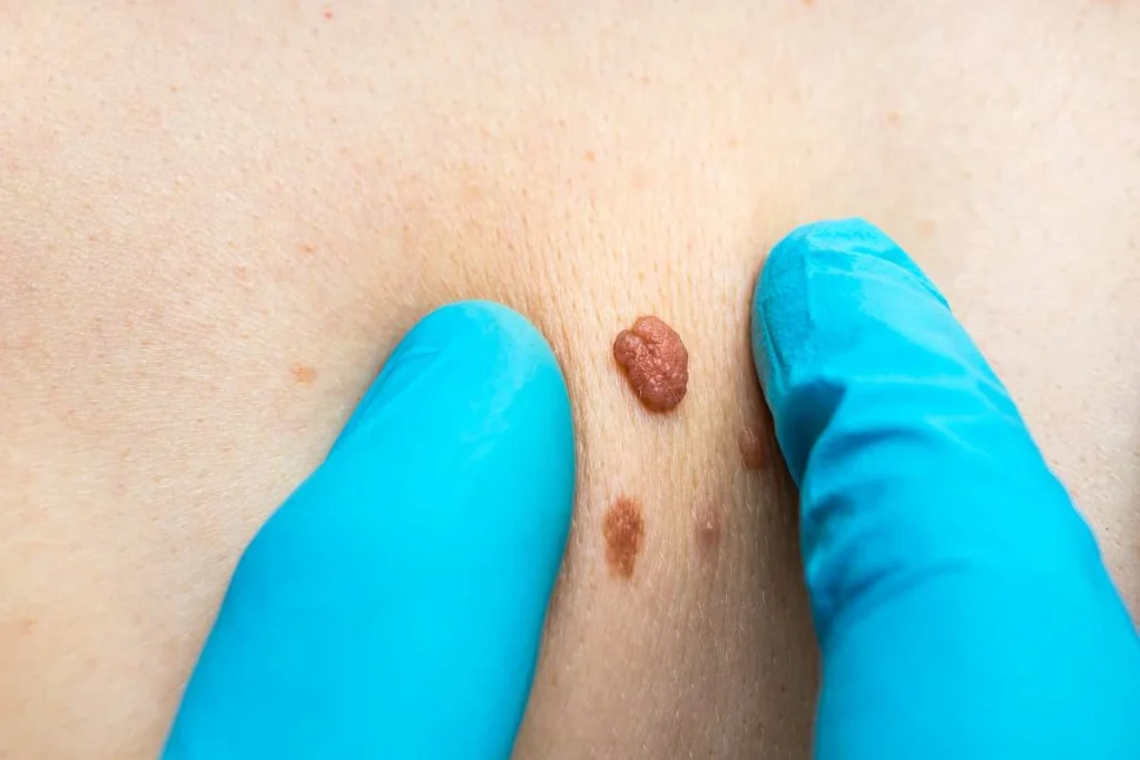 Consultant examining a skin tag Hereford