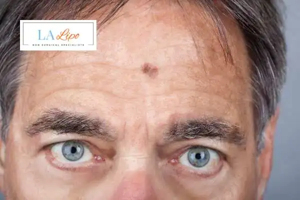 Solar Lentigo Removal Hereford image of man with mark on his forehead