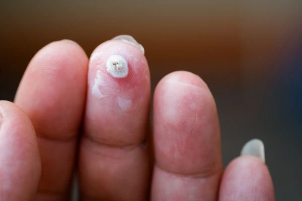 wart on person finger - cryotherapy to treat from LA LIPO Hereford