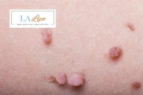 Does cryopen skin tag removal Hereford hurt? Find out now call our team today!