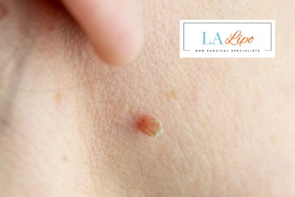 Book skin tag removal Hereford today speak to our team now!