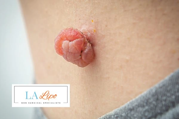 Interested in skin tag removal Hereford? Concerned about the pain? Find out more today!