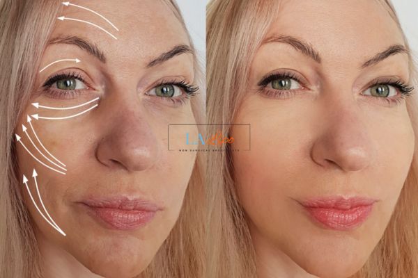 Morpheus 8 results Hereford face lift.