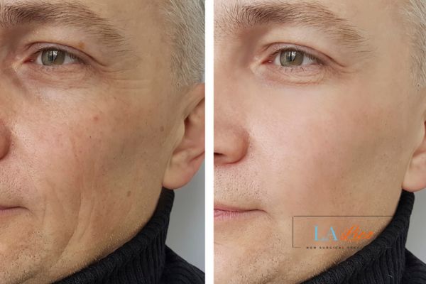 See the amazing results of Morpheus8 Treatment Hereford!