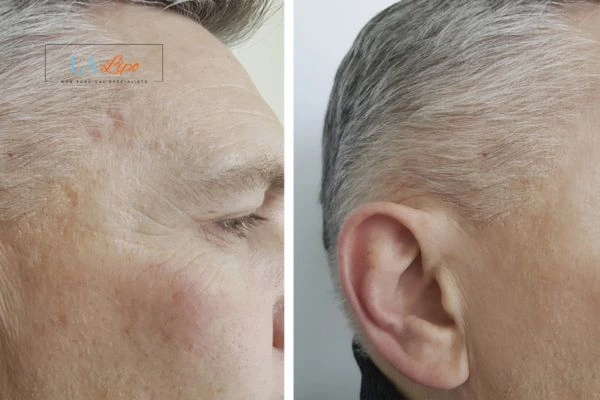 Mens Before & After Morpheus 8 Results Hereford
