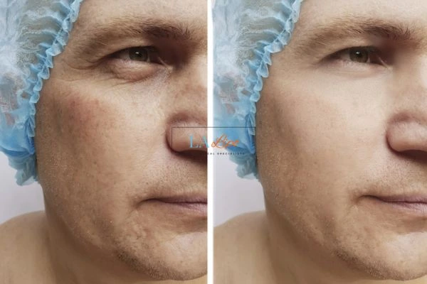 Before and after Morpheus 8 Results Hereford