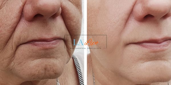 Older lady deeper wrinkle reduction - LA LIPO Morpheus 8 Results Hereford