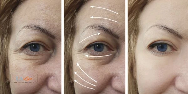 Amazing eye lift Morpheus 8 results Hereford