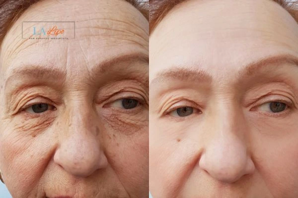 The powerful benefits of Morpheus8 Treatment Hereford - Call Our team today!