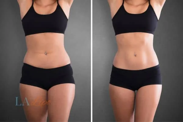 before and after results of non-surgical treatment to help a woman's body image and mental health Hereford