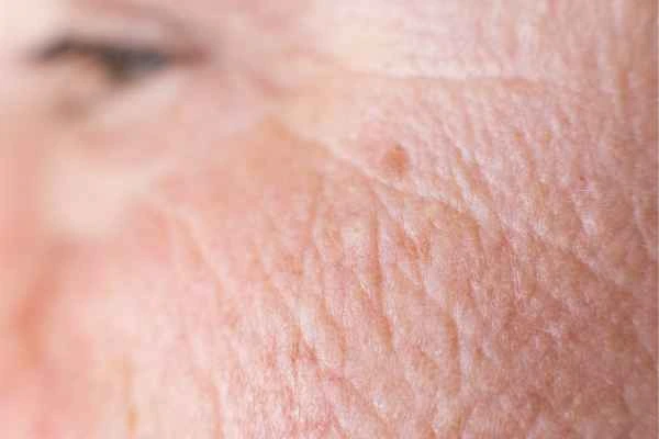 close up picture of a woman's face showing an age spot Hereford