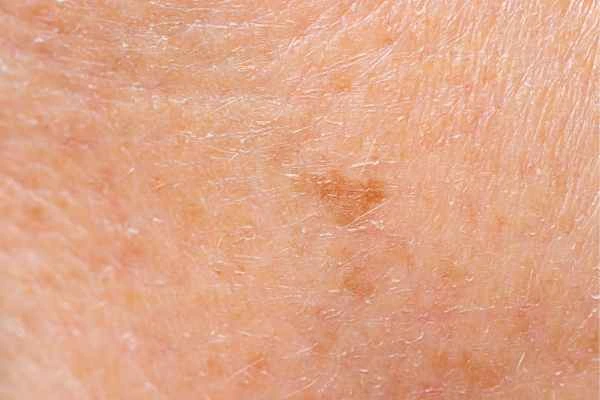 close up picture of age spots Hereford