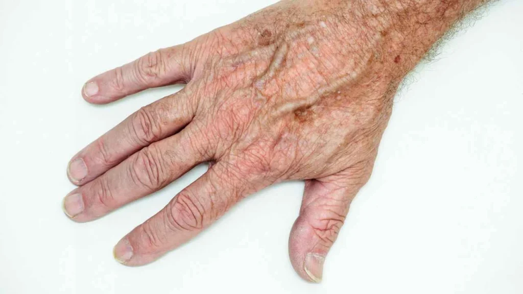Male hand showing age spot Hereford