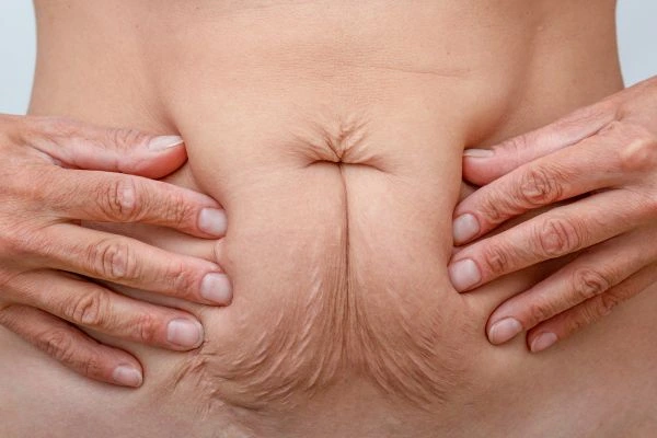 Image of a woman's stomach with loose skin - example of skin tightening Hereford options