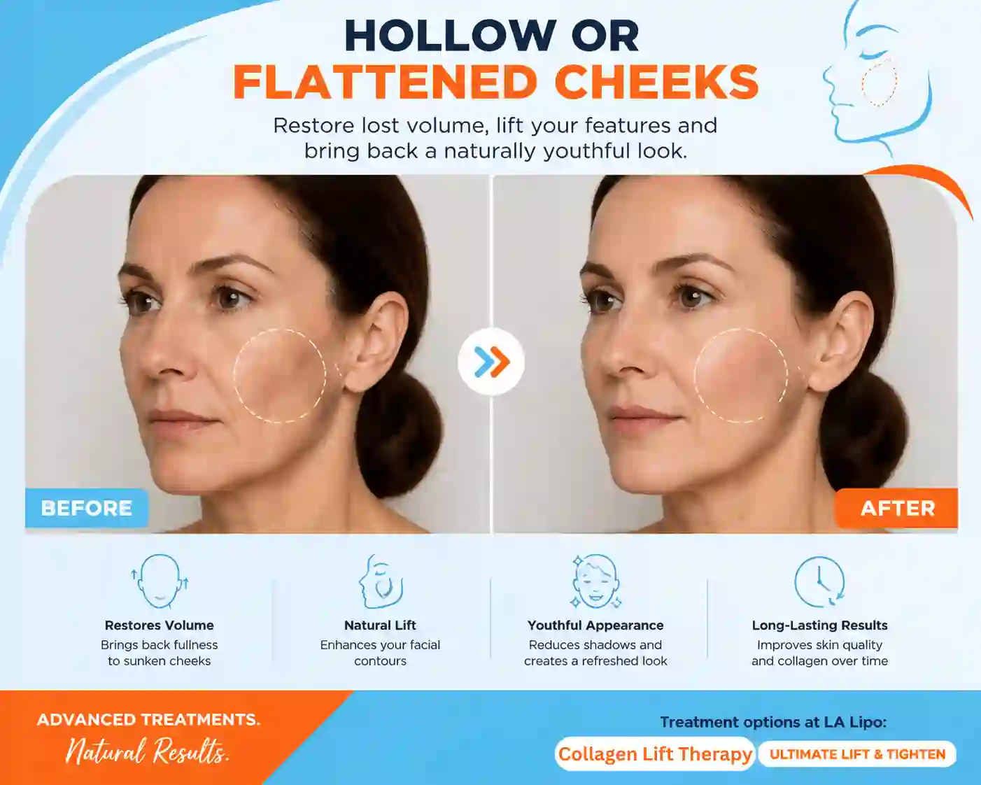 Sign #4: Hollow or Flattened Cheeks Hereford